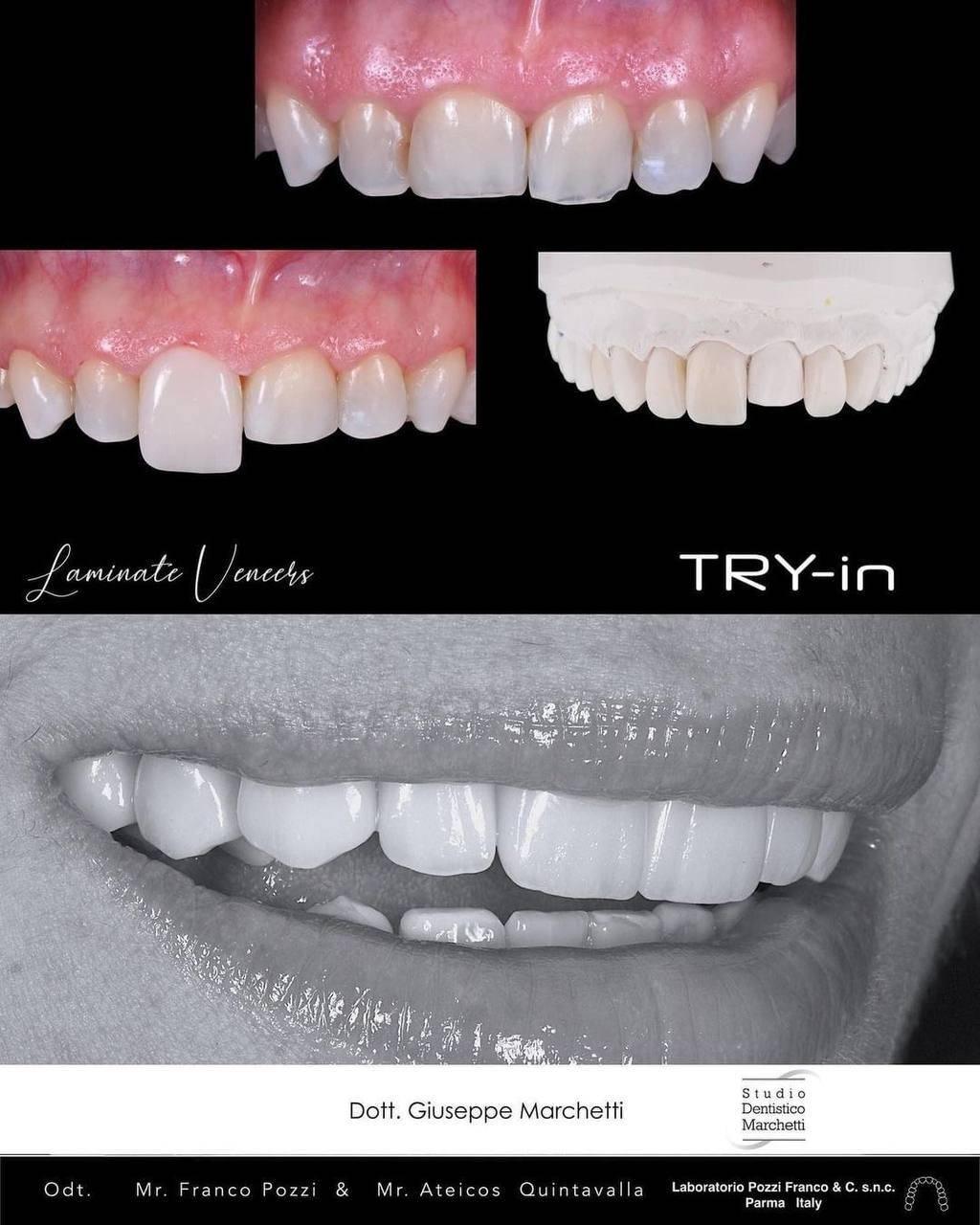 Ceramic Restorations: Veneers, Inlays, Crowns