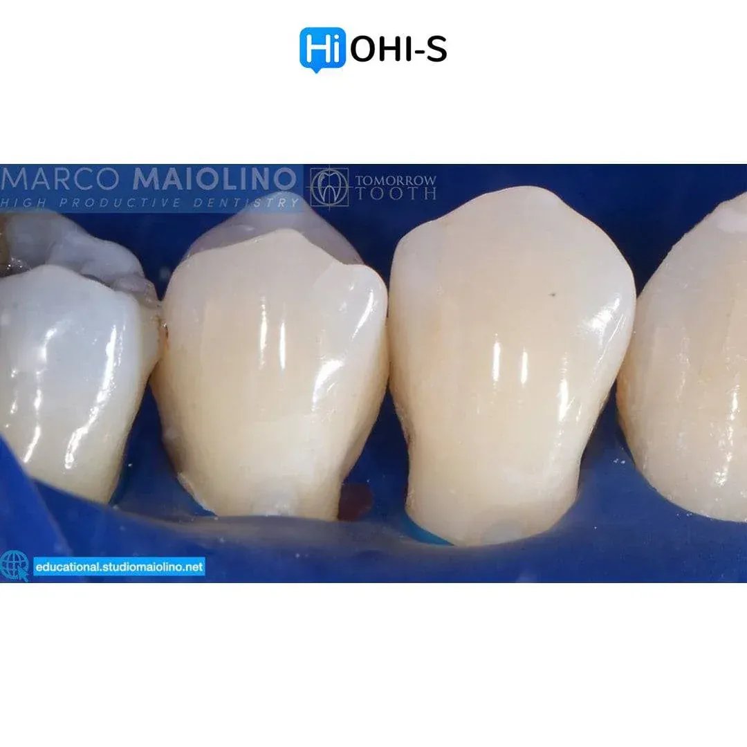 Bioclear Dental Restoration
