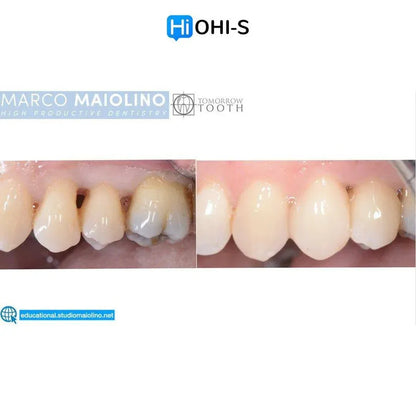 Bioclear Dental Restoration