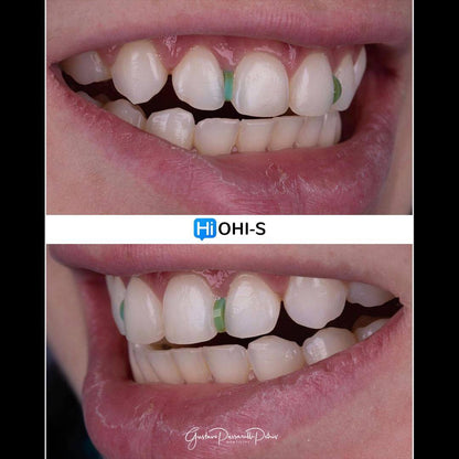 Composite Veneers, All Restorative Techniques