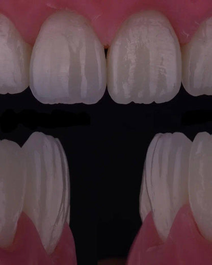 Composite Veneers, All Restorative Techniques