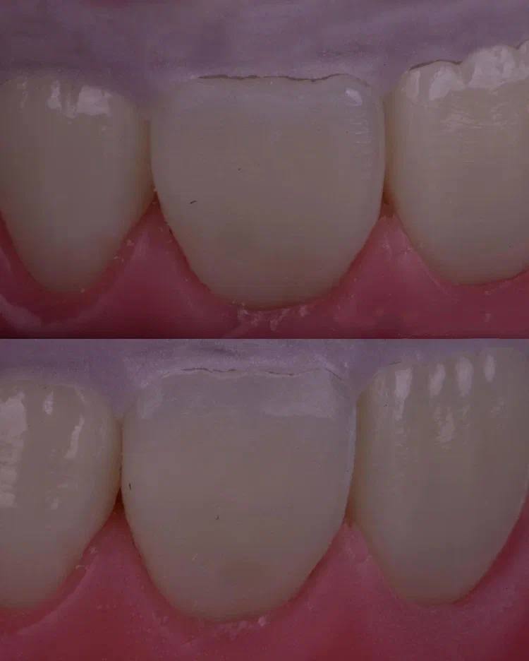 Composite Veneers, All Restorative Techniques