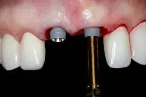 Online Residency Program A-Z in Implant Dentistry