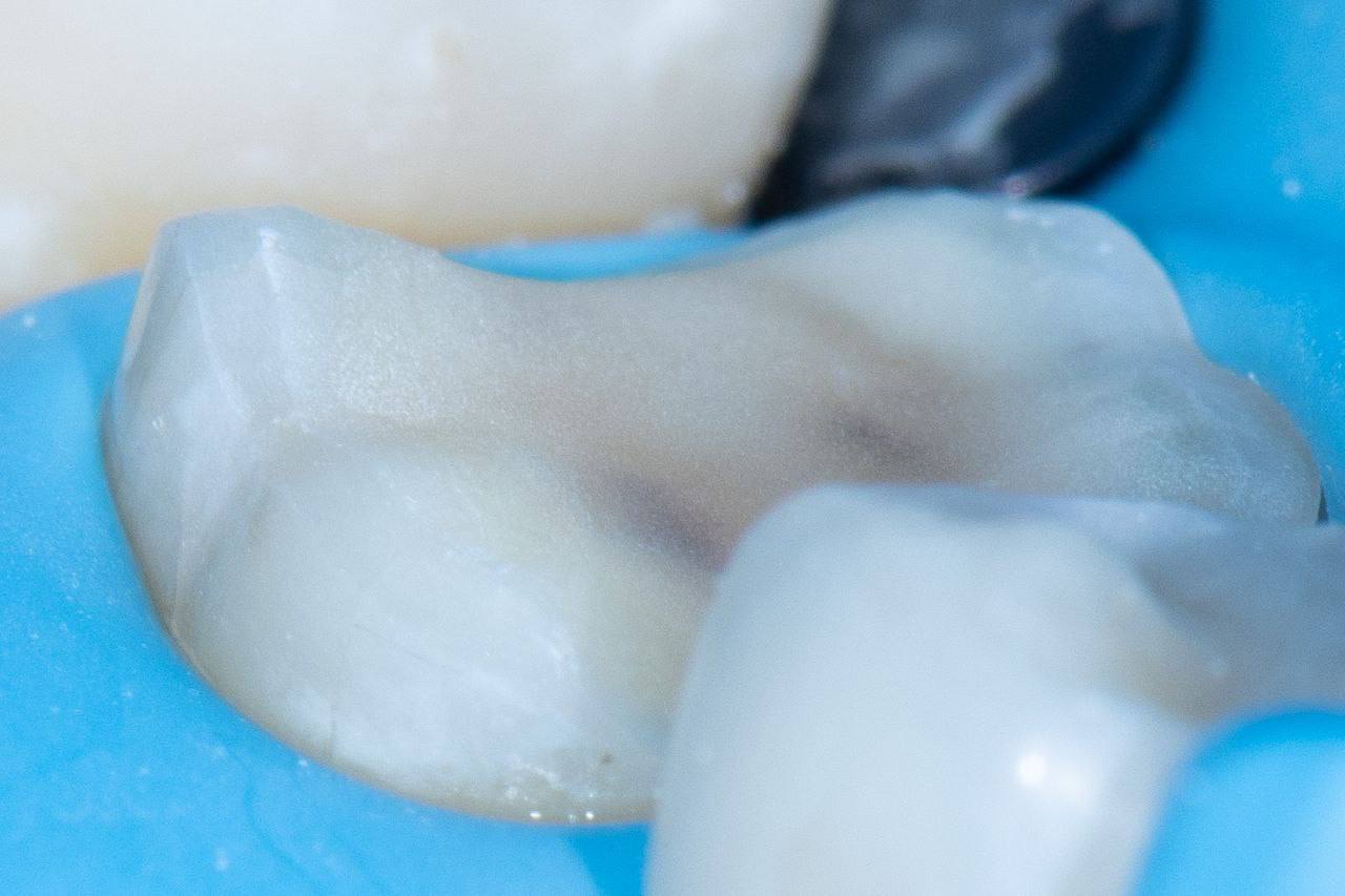 Overlay, Onlay and Advanced Adhesion