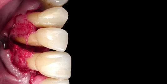 Periodontitis – Surgical and Non-Surgical Treatment Methods
