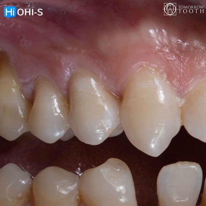 Vertical Preparation Protocols: The Complete Guide in 24 Lessons from Tomorrow Tooth